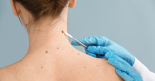 mole removal